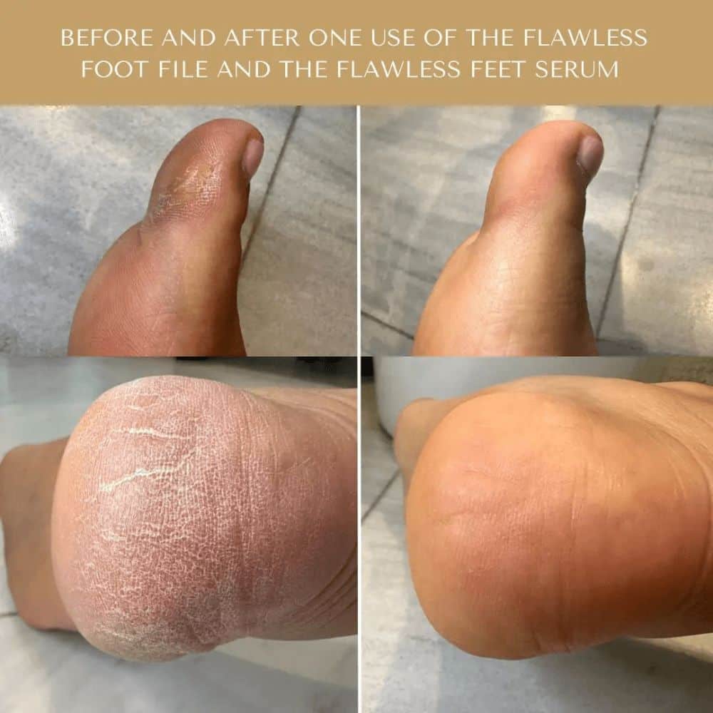 Flawless Feet System Set